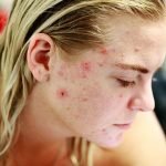 Homeopathy Treatment for Acne